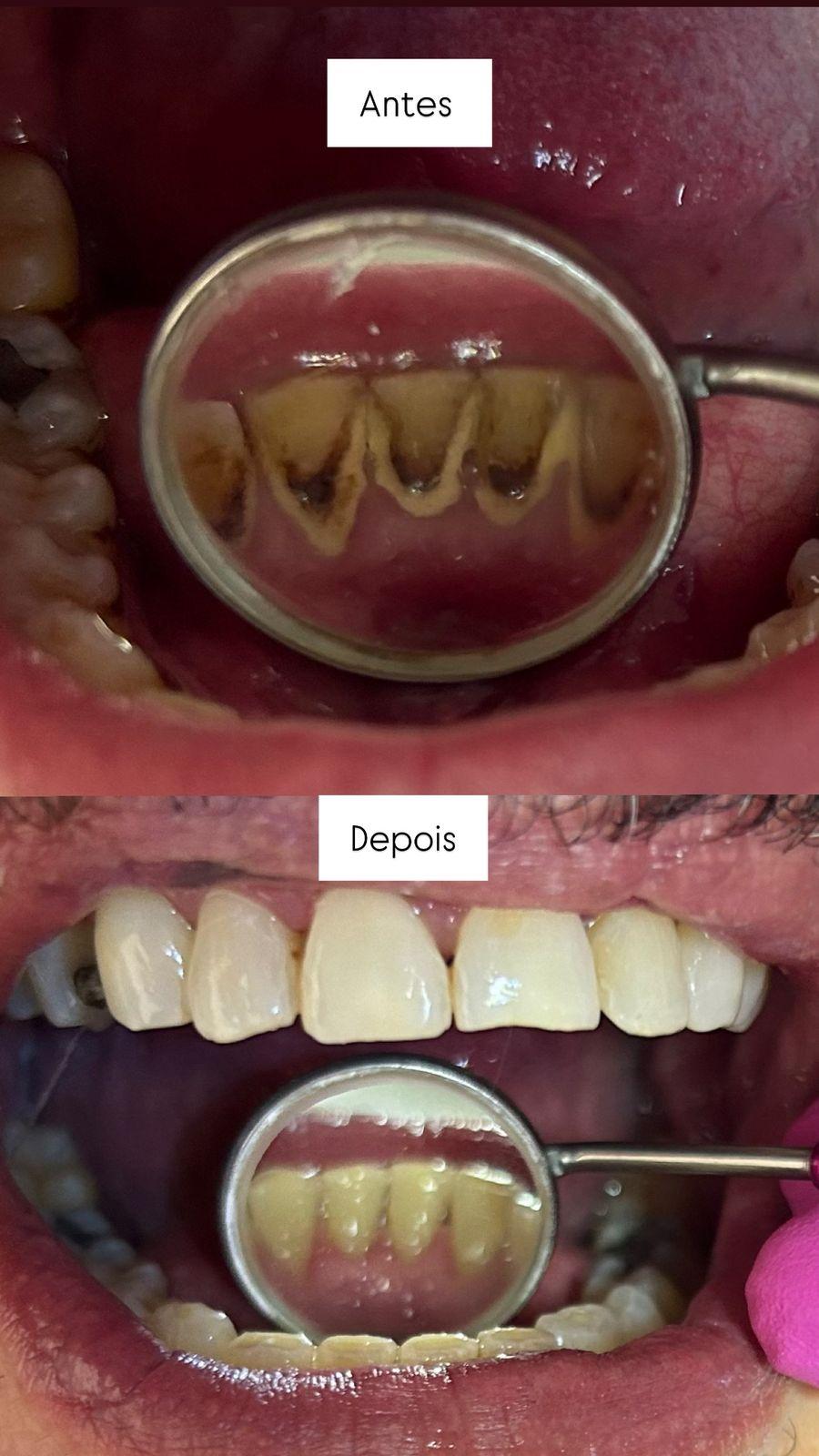 Clareamento dental em andamento