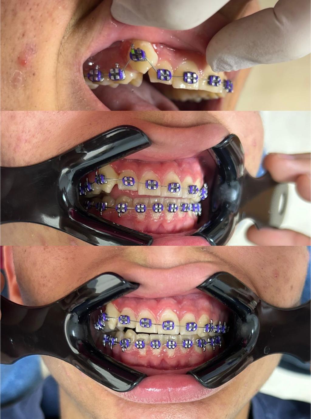 Ortodontia com aparelho ortodôntico