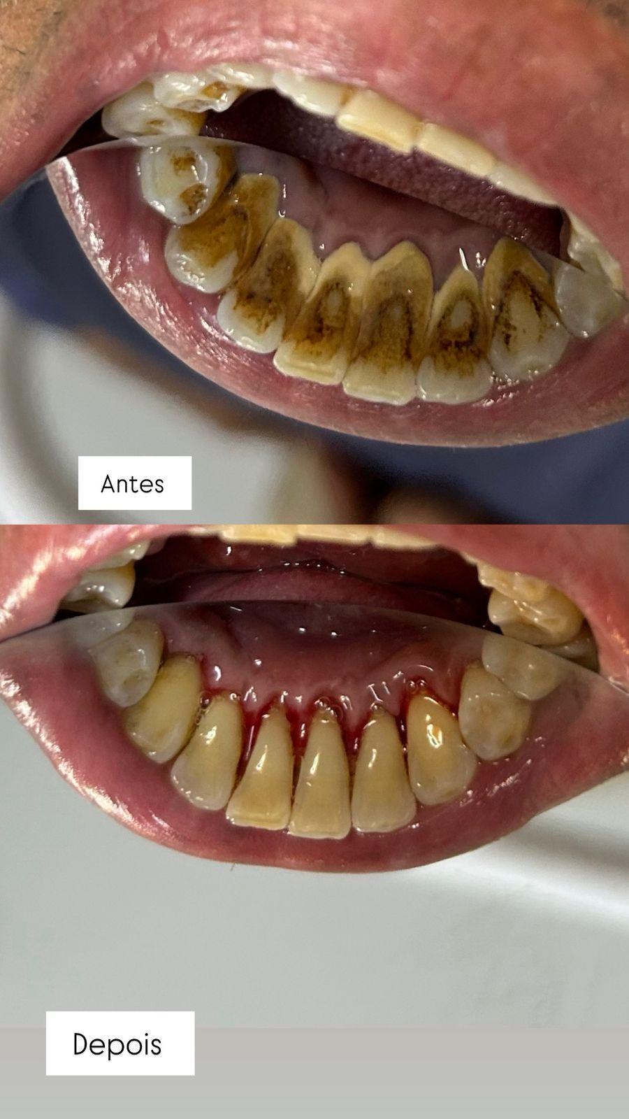 Procedimento de limpeza dentária